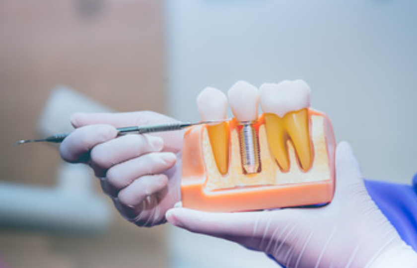 Featured image for “ Dental Implant Restoration Options”