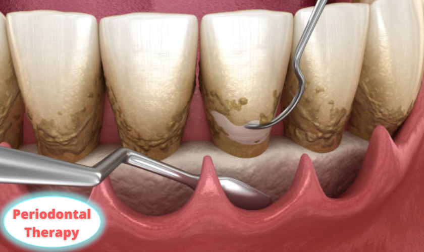 Featured image for “How  Periodontal Therapy Is Helpful In Avoiding Gum Disease”